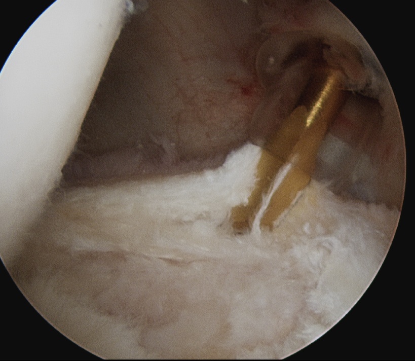 Posterior Labral Tear Cyst 2